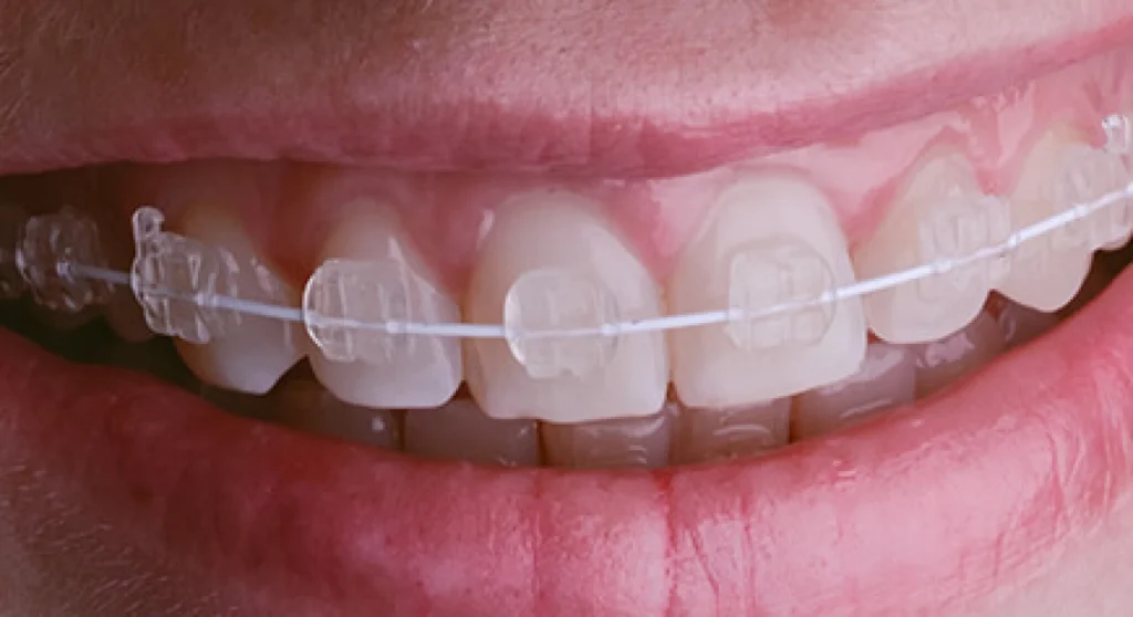 Clear Ceramic Braces