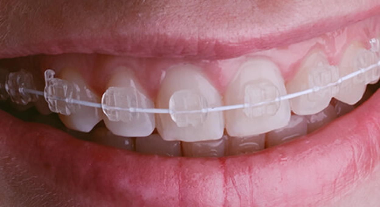 Clear Ceramic Braces