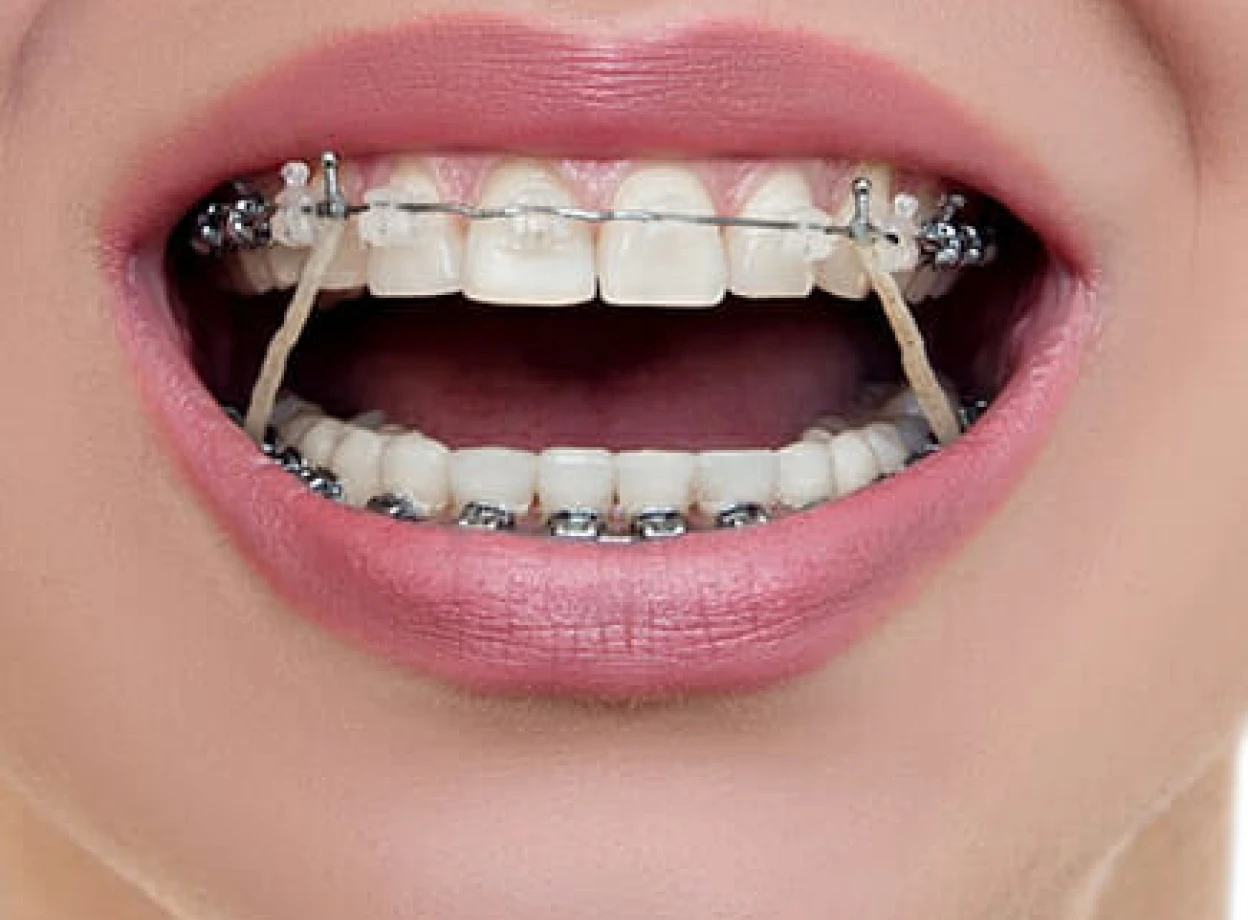 Elastics