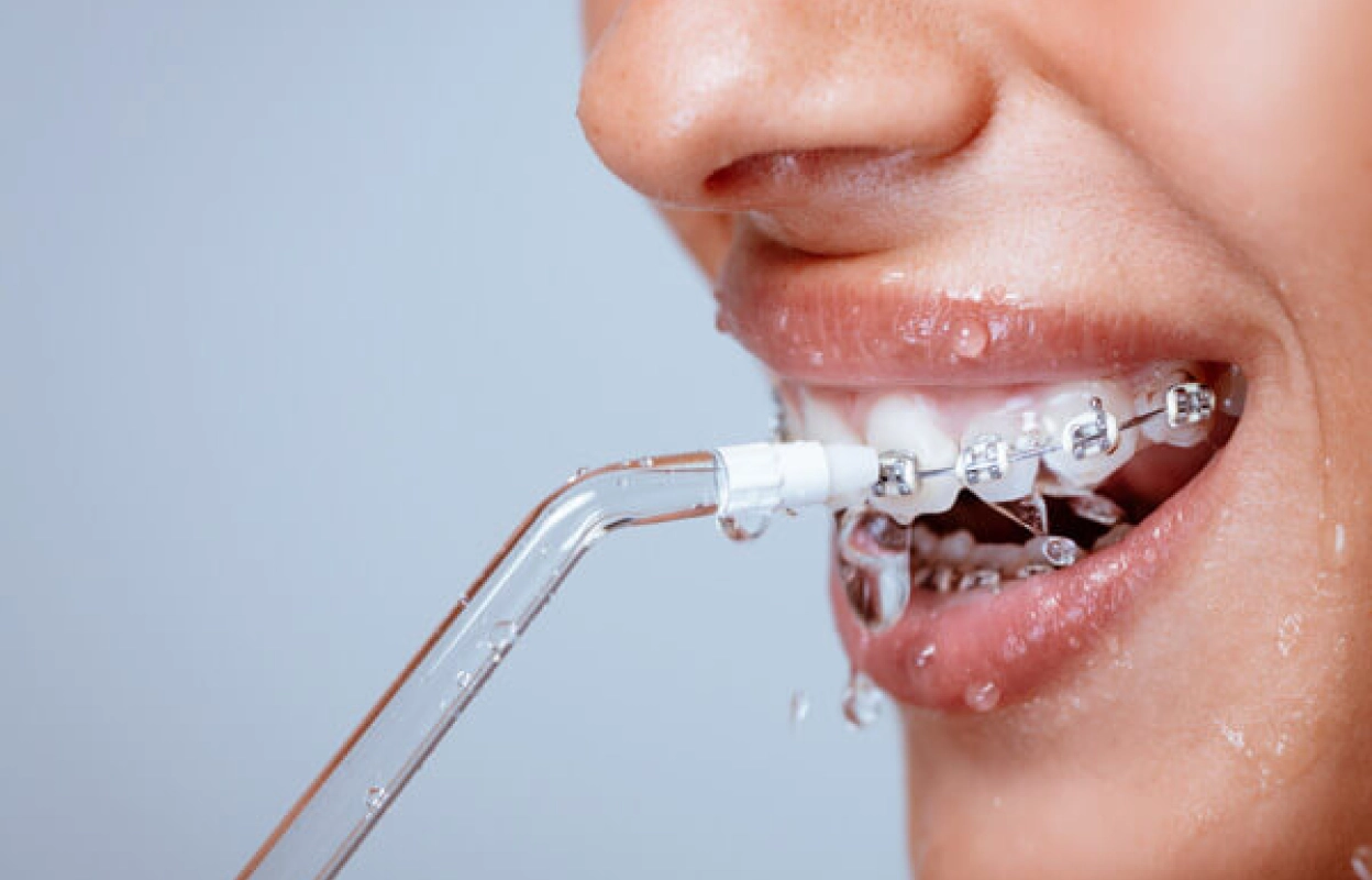 How to Floss with Braces