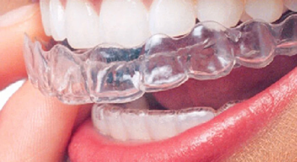 Invisalign Clear Aligners