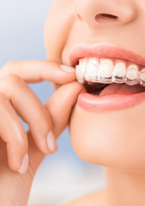 Invisalign