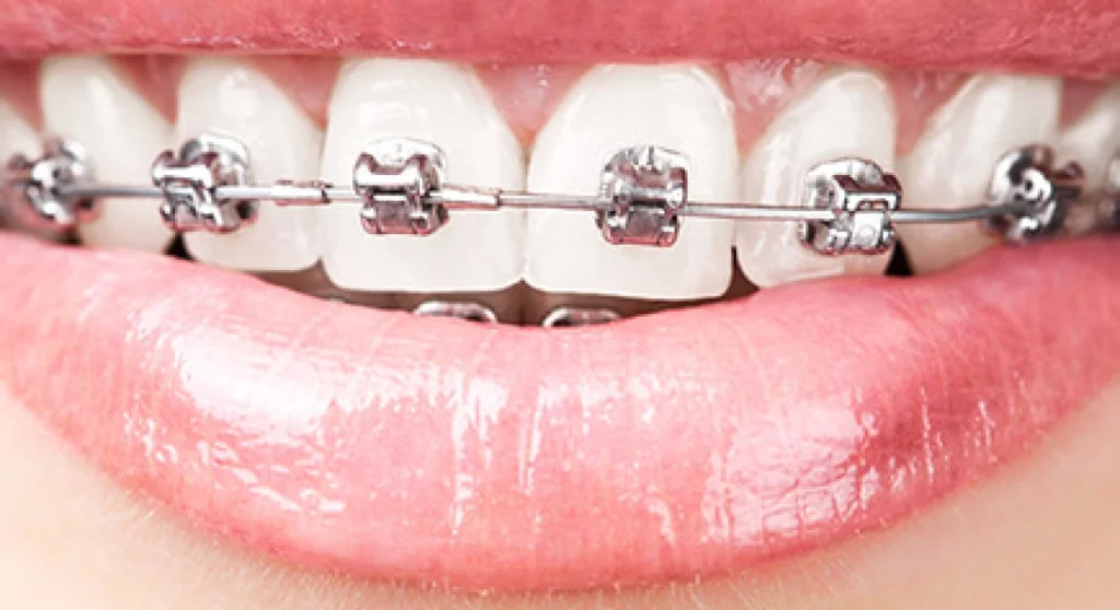 Metal Braces