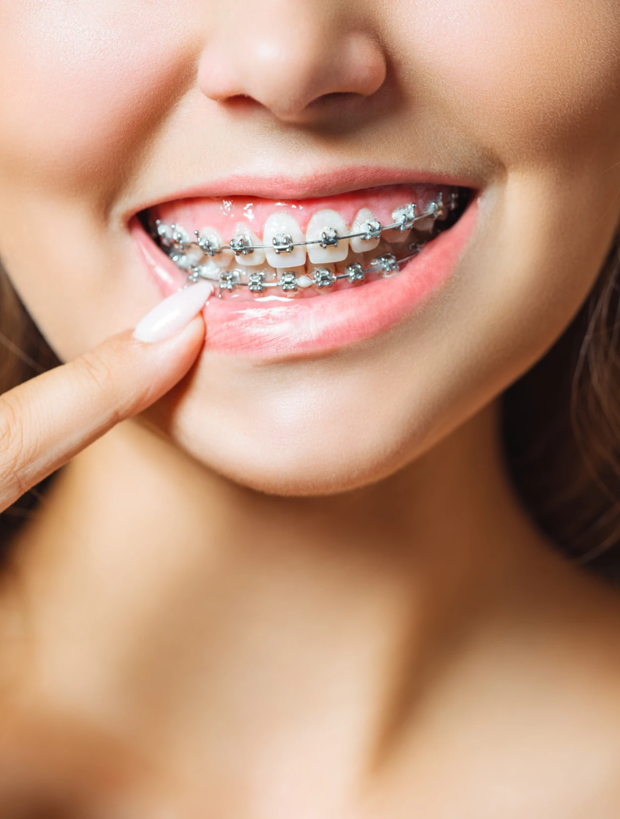 Problems with Braces