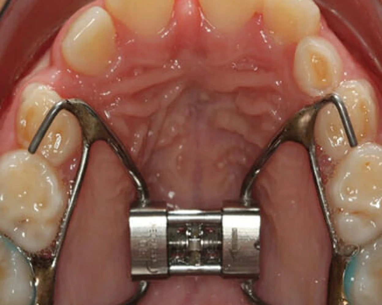 Rapid Palatal Expander