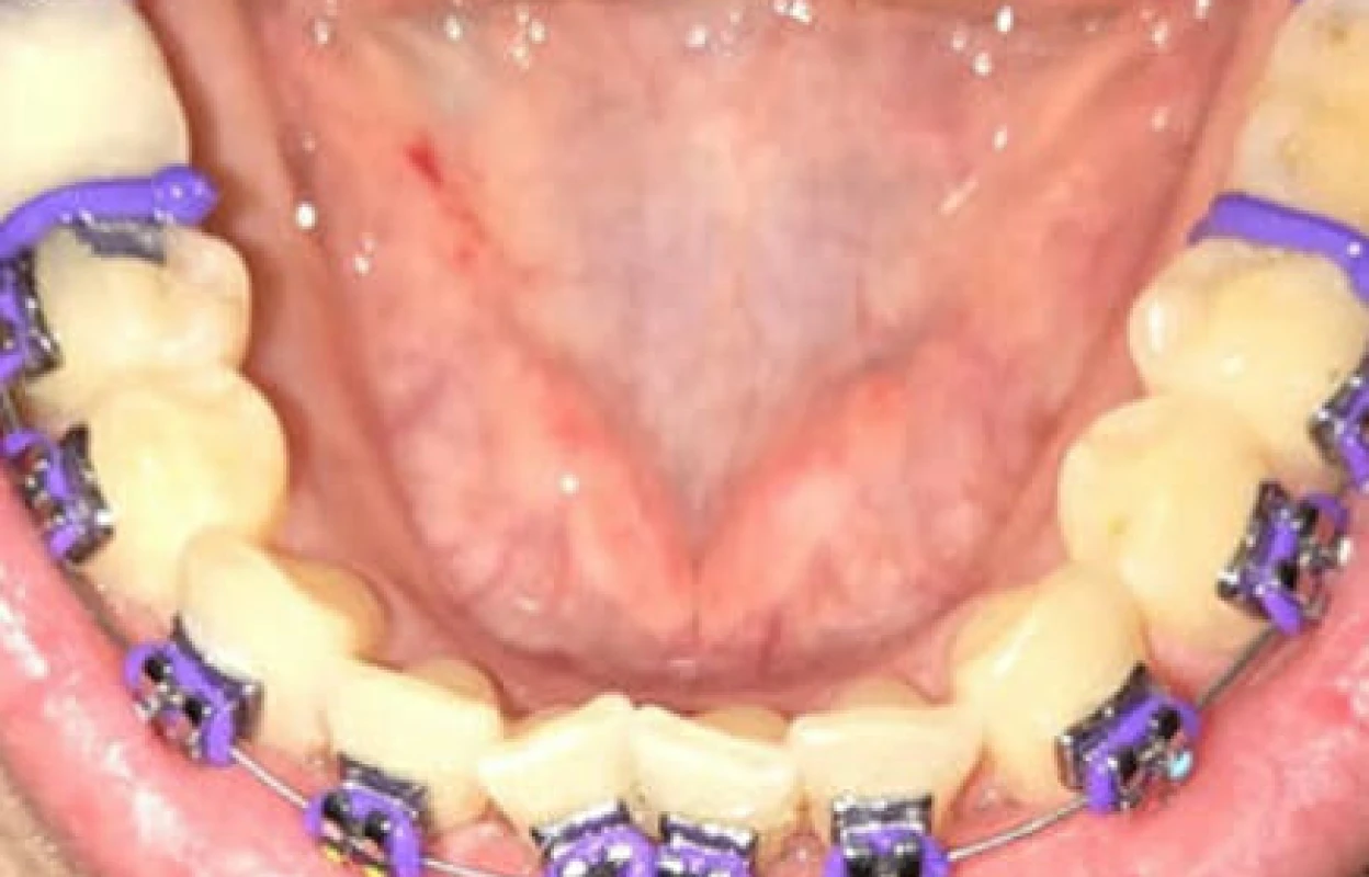 Spacers