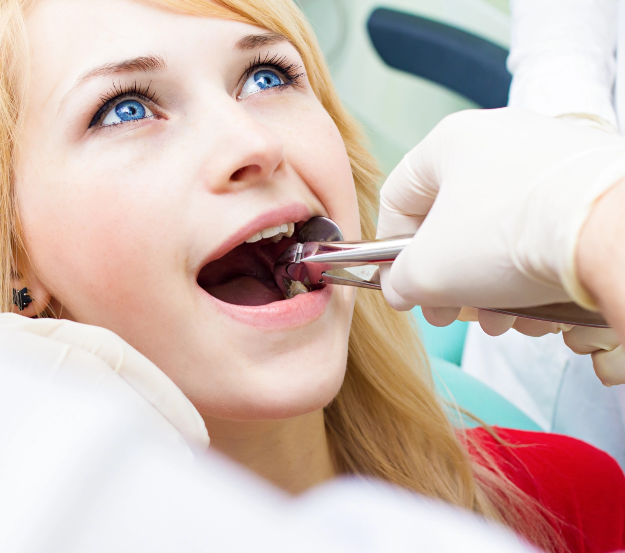 The Process of Extracting Wisdom Teeth