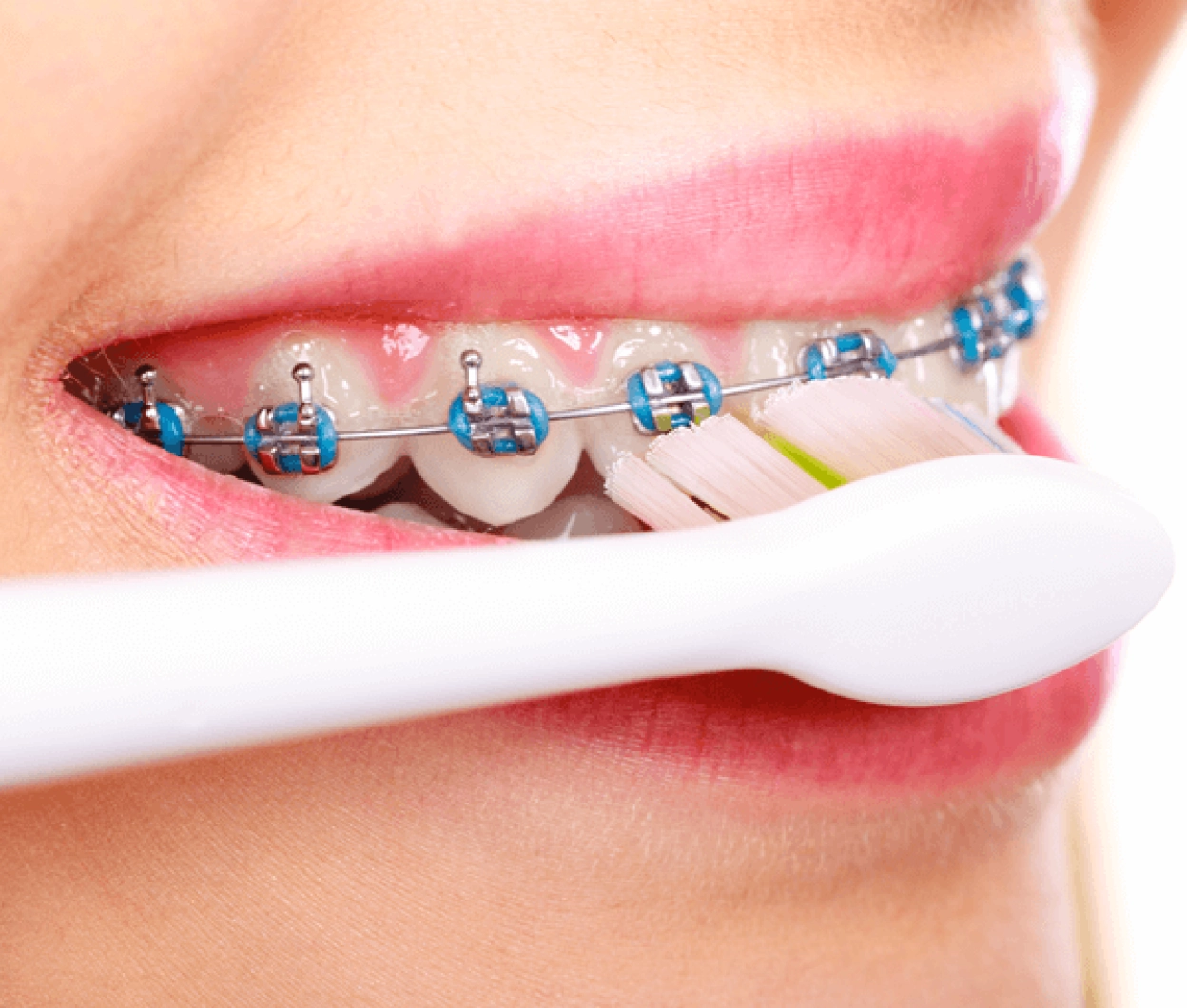 Tools for Brushing with Braces