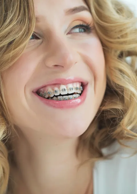 Types of Braces