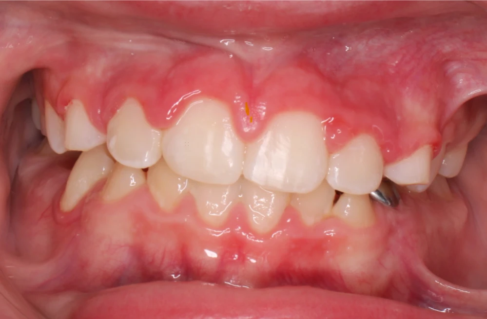 Ortho After 1Ortho Before 1