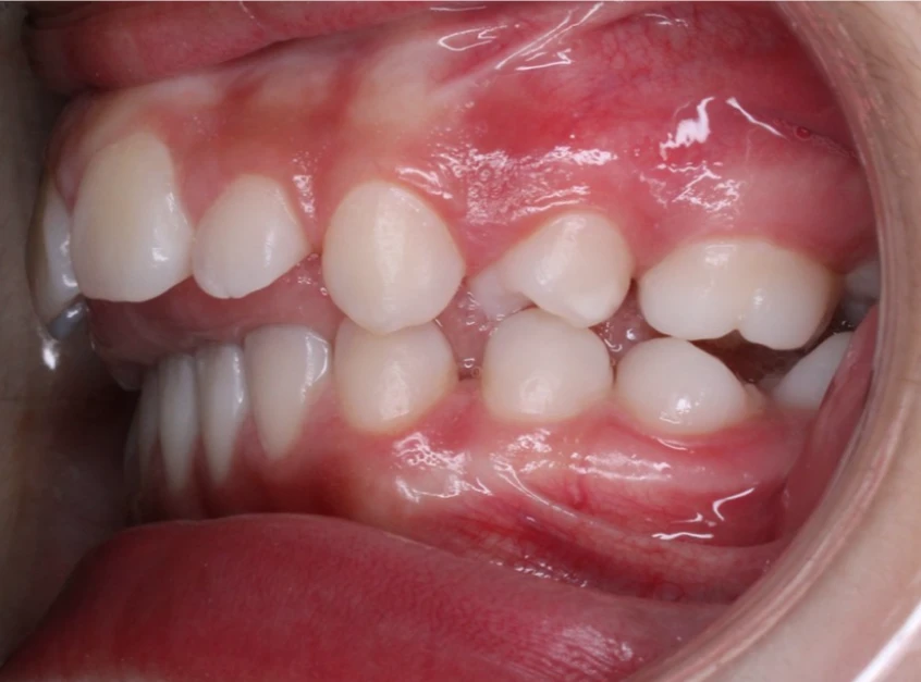 Ortho Before 4