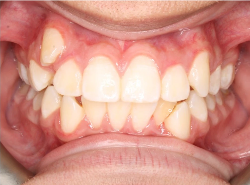 Ortho-Before-5