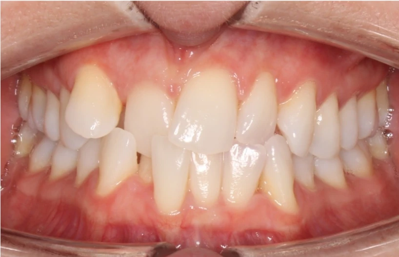Ortho Before 6
