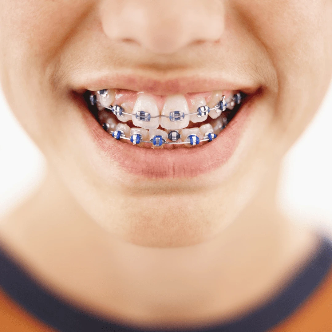 Why Choose Braces New Image