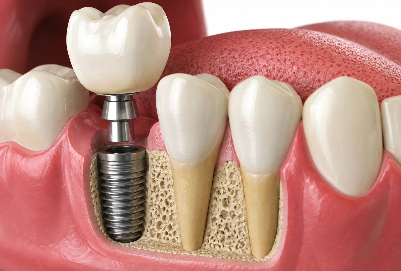 Dental Implant