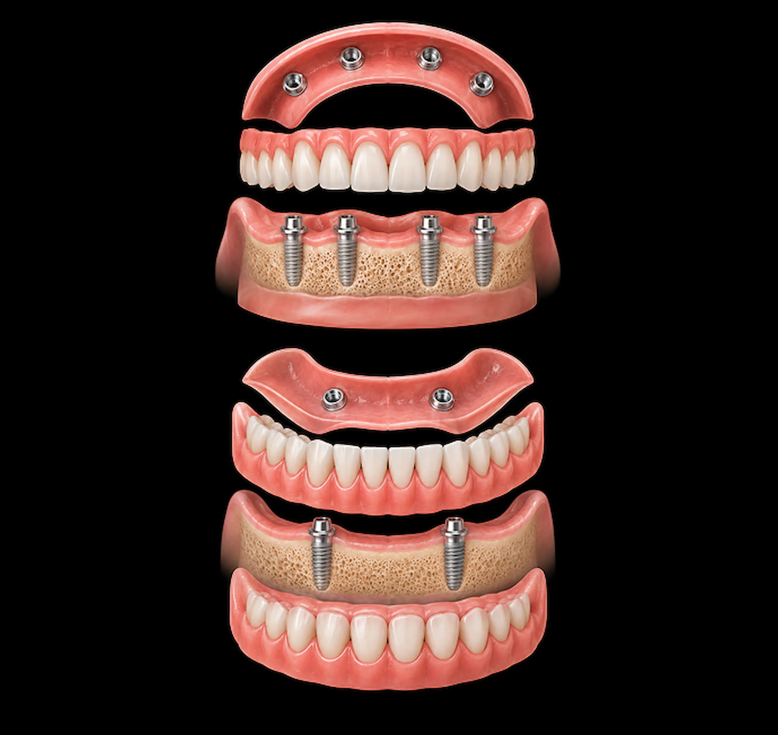 Implant Retained Denture New