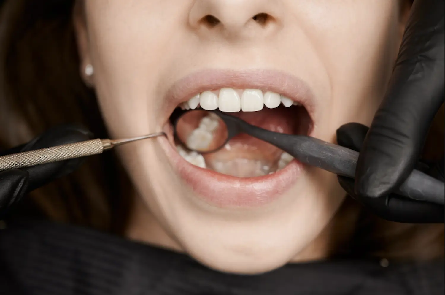 Wisdom Tooth FAQ Image 1
