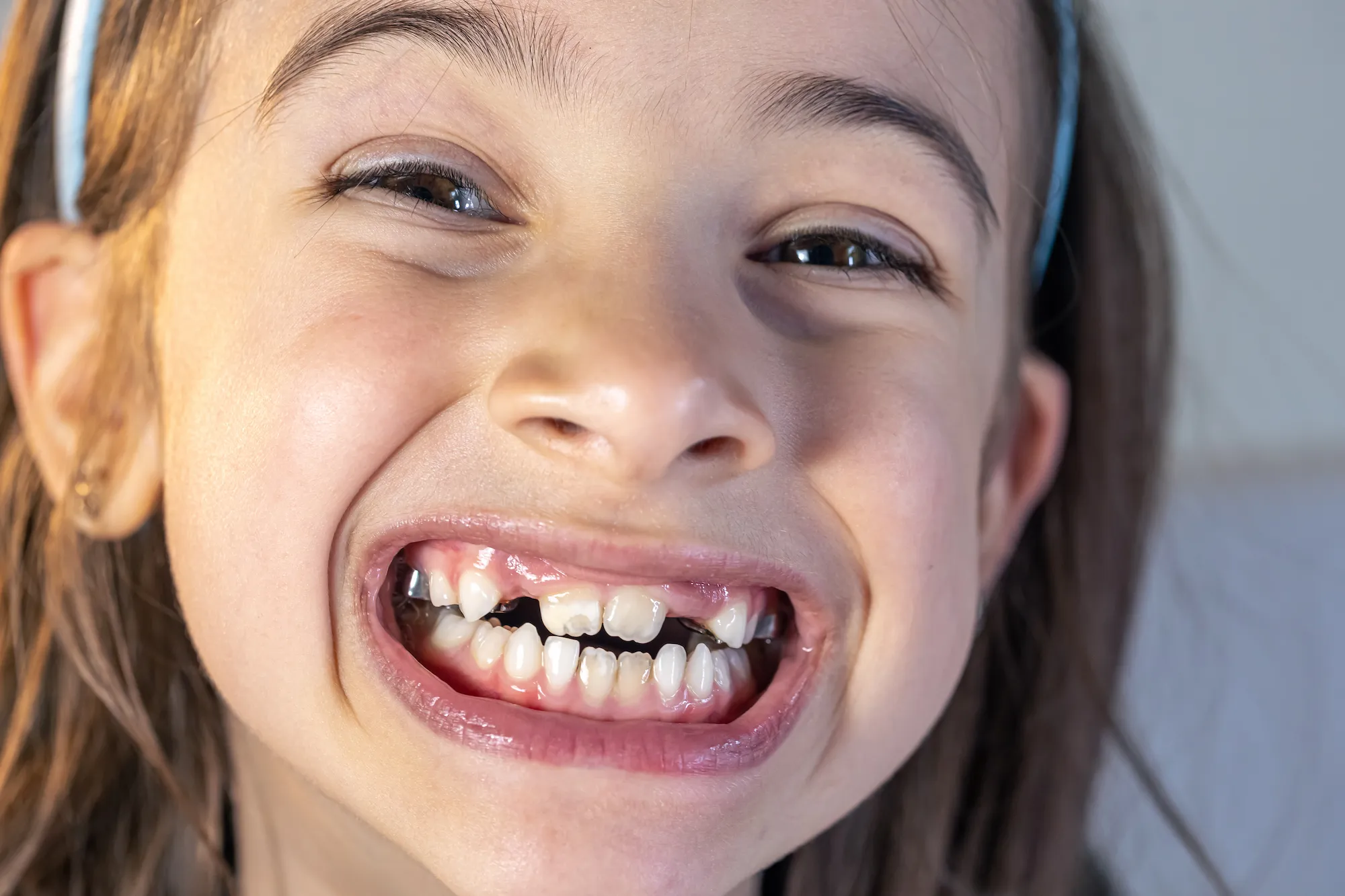pediatric-dentistry-dental-crown